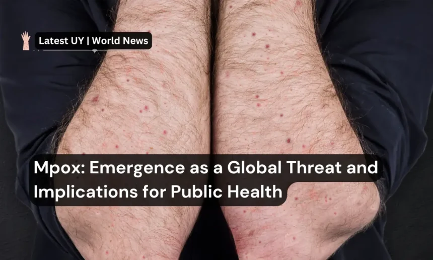 Mpox Emergence as a Global Threat and Implications for Public Health