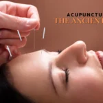 Acupuncture